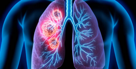 Pulmonale defende que é prioritário avançar com rastreio ao cancro do pulmão em Portugal