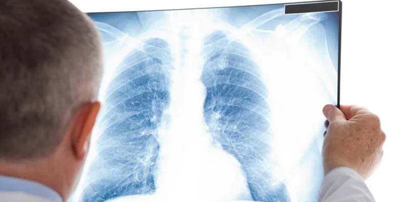 Cancro do pulmão é mais expressivo em Espanha do que em Portugal