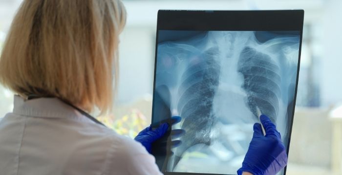 Estudo identifica diferentes formas de DPOC associada à hipertensão pulmonar
