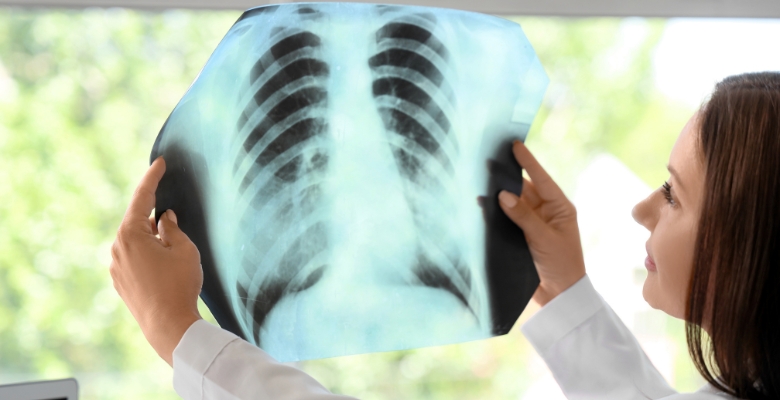 Fibrose pulmonar