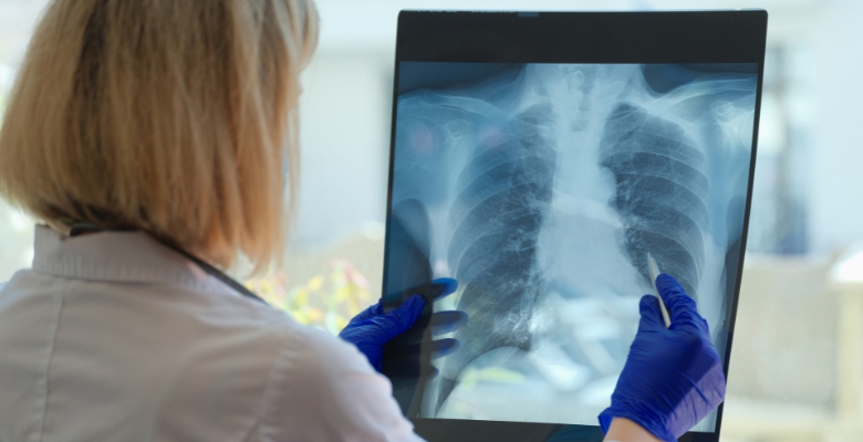 fibrose pulmonar