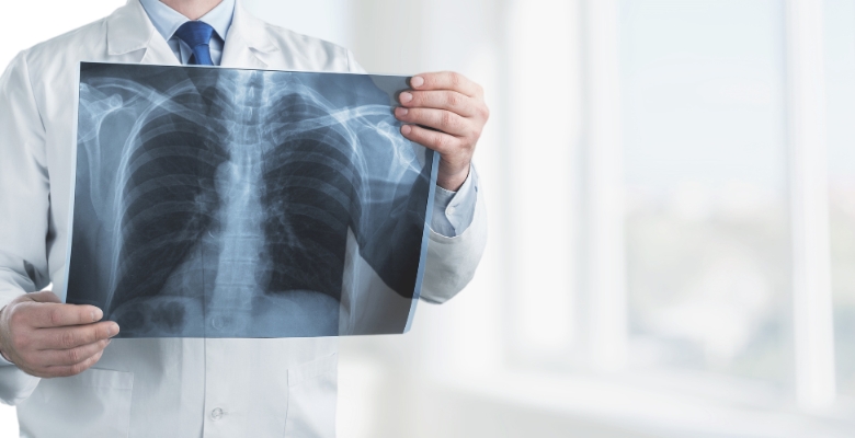 fibrose pulmonar