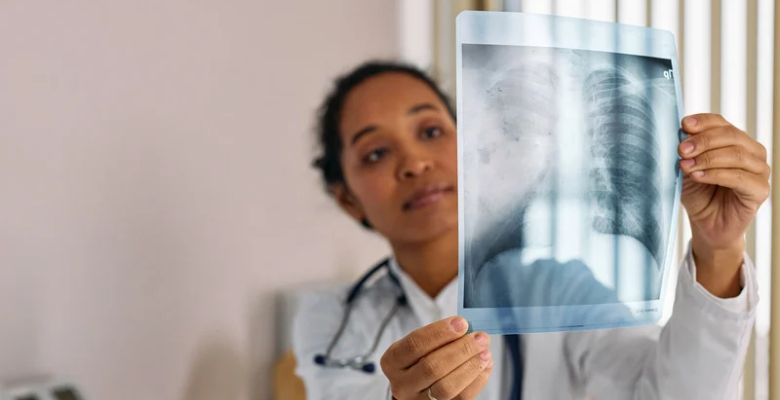 Doença pulmonar por micobactérias