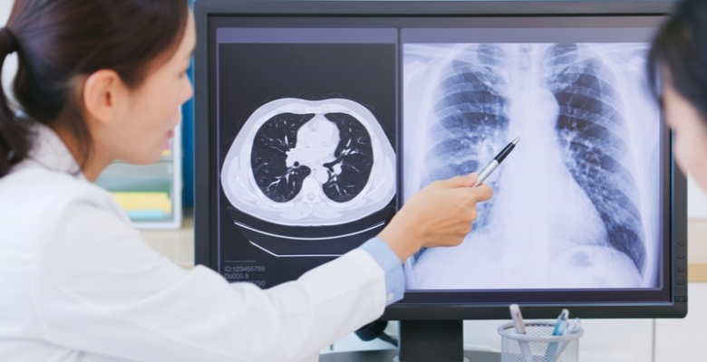 cancro do pulmão de células não pequenas